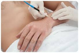 Electrolysis is a cosmetic procedure for removing unwanted hair. Sydney Electrolysis Permanent Hair Removal Nicolsons Clinic In Sydney