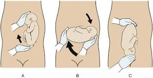 Image result for External Cephalic Version