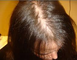 Not surprisingly, it is possible. Hair Loss Thinning Hair Shampoo Sulfates Could Be The Culprit Susy Sayz
