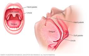In the same general area as before, like nearby lymph nodes. Soft Palate Cancer Middlesex Health