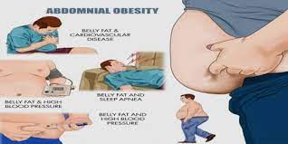 Abdominal Obesity Msrblog