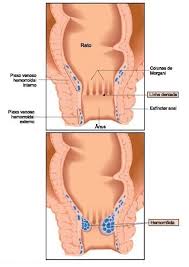 Doencas No Anus E Reto Hemorroidas E Fissura Anal