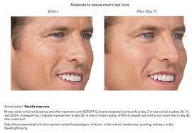 Clinical analysis of 86 botulism cases caused by cosmetic injection of botulinum toxin (bont) // medicine (baltimore). Botulinum Toxins Knoxville The Face Place Knoxville Tn