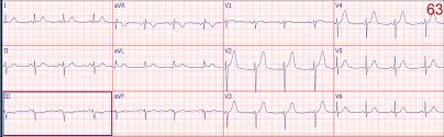 Dr Smiths Ecg Blog I Was Reading A Stack Of Ecgs