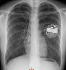 Lesen sie mehr über ablauf und mögliche risiken einer. Der Implantierbare Cardioverter Defibrillator Bei Padiatrischen Patientinnen Und Jungen Erwachsenen Pdf Kostenfreier Download