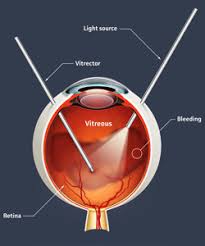 People living with diabetes should have eye screening as part of their diabetes checks. Diabetic Retinopathy Elgin Il