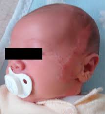 It is also referred to as organoid nevus. Ceruminous Adenoma Ceruminoma Arising In A Nevus Sebaceus Of Jadassohn Within The External Auditory Canal Of A 3 Year Old Boy A Case Report Sciencedirect