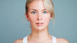 8 cremes, gels und andere lokal wirksame pflanzliche mittel. Creme Fur Rosacea Die 3 Besten Cremes Laut Dermatologen