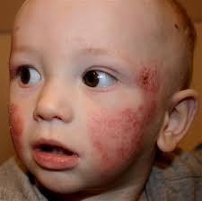 Image result for Atopic Dermatitis