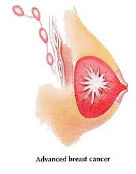 It can also occur in the armpit area, where there is more breast tissue (a.k.a. Different Kinds Of Breast Lumps Stony Brook Cancer Center