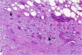 Pancreatic cancer can also make it difficult for the intestines to help break down fats, so stools may become greasy and float in the toilet. Tumour Microenvironment Of Pancreatic Cancer Immune Landscape Is Dictated By Molecular And Histopathological Features British Journal Of Cancer