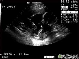 Ultrasound Pregnancy Information Mount Sinai New York
