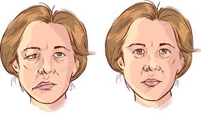 For some, however, the symptoms may last longer. Bell S Palsy Familydoctor Org
