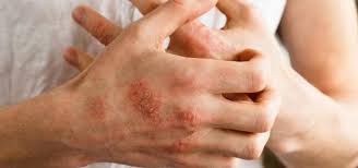 Dermatitis kontak terjadi akibat kontak langsung dengan. Kulit Gatal Punca Simptom Dan Rawatan Spa Bekam Ar Rayyan