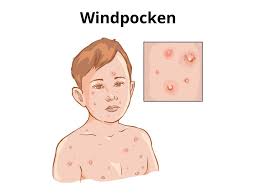 Windpocken (varizellen) gelten als klassische kinderkrankheit. Windpocken Varizellen