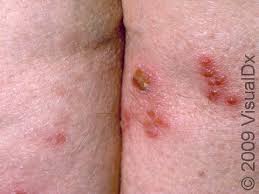 Image result for genital herpes