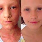 アトピー性皮膚炎を三ヶ月で克服した方法 health and beauty tips body health skin eczema treatment