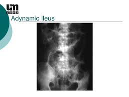 Image result for Adynamic Ileus