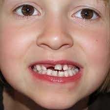 While it may be healthy to gently remove a baby tooth that is already loose, you should never attempt it for an. How To Pull A Tooth Safely Without Pain When Not To Jefferson Dental Orthodontics