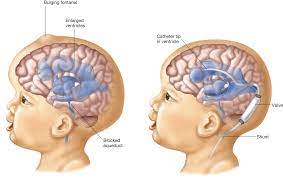 Hydrocephalus Fetal To Newborn Care Center Dayton