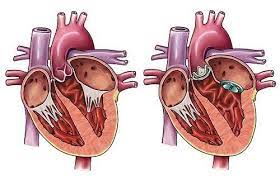 Heart Valve Replacement Surgery Cost in India | Heart Valve Surgery