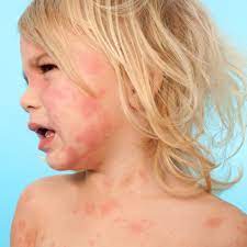 Hives In Children Babycenter