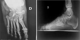 Selene parekh from the north carolina orthopedic clinic performs an ehl tendon transfer for anterior tibial tendon chronic rupture. Rupture Du Tendon Tibial Anterieur Chez Un Footballeur A Propos D Un Cas Et Revue De La Litterature Sciencedirect