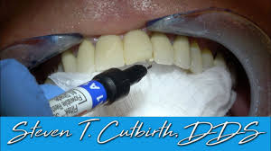 Whether you already have or are actively looking for dental bridges near you, there is a good chance you might have begun to consider what will happen if your dental bridge becomes loose. How To Bond A Chipped Porcelain Bridge Dental Minute With Steven T Cutbirth Dds Youtube