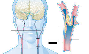A majority of the symptoms associated with clogged neck arteries are related to brain function. The Scan That Saved My Life Wsj