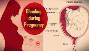 During this phase, women find breathing difficult, and they head to the washroom even more often! Bleeding During Pregnancy What Are The Reasons