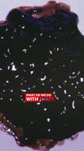 Image result for dark black stool human poop