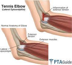 Tennis elbow is the common name describing the condition lateral epicondylitis, or inflammation of the outside portion of the elbow resulting in soreness and tenderness. Tennis Elbow Exercises For Therapy The Complete Overview Pdf Handout