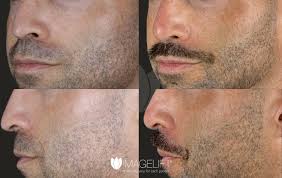 The Popularity of Liquid Rhinoplasty