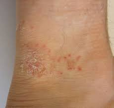 Candida Hefepilz Symptome Im Uberblick Candidapatient De