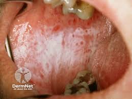 Image result for lichen planus on tongue)