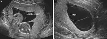 What is the formula of lambda? Isuog Practice Guidelines Role Of Ultrasound In Twin Pregnancy Khalil 2016 Ultrasound In Obstetrics Amp Gynecology Wiley Online Library