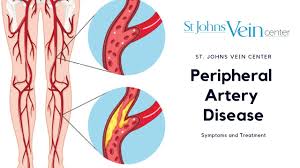 Arteries are usually positioned deeper within the body. Peripheral Artery Disease Diagnosis And Treatment Options