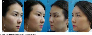 PDF] Hyperdilution of CaHA fillers for the improvement of age and  hereditary volume deficits in East Asian patients
