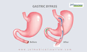 Maybe you would like to learn more about one of these? How To Get Weight Loss Surgery Approved Jet Medical Tourism In Mexico