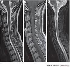 Widespread use of mri (magnetic resonance imaging) has revolutionized the ability to diagnose multiple sclerosis. Magnims Consensus Guidelines On The Use Of Mri In Multiple Sclerosis Clinical Implementation In The Diagnostic Process Nature Reviews Neurology