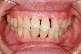 Guest post by erin josefchak millions of north americans are affected by periodontal (gum) disease. Periodontitis Treatment Home Remedies And Symptoms
