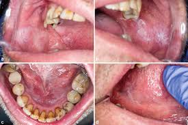 Image result for spinocellular carcinoma of the oral cavity