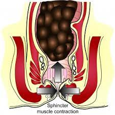 Artificial Sphincter Surgery For Bowel Incontinence