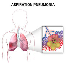 Image result for Pneumonia