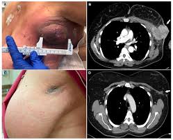 Image result for Inflammatory breast cancer