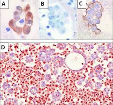 Certain factors can greatly increase risk of melanoma, including an individual&#x27;s geographic region, ethnicity and sun exposure. Immunohistochemical Evaluation For Mpm Vs Reactive Mesothelium Download Scientific Diagram