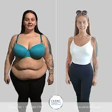 After 18 months, the total percentage of excess weight lost can reach 70 to 80 percent. Gastric Sleeve Before After Photos Clinic 360