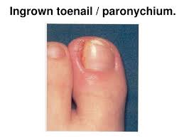 Image result for paronychium