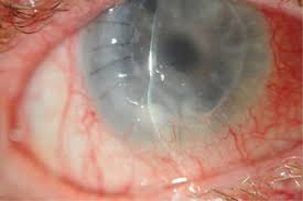 Herpes simplex virus (hsv) keratitis is the leading cause of corneal blindness in developed as well as developing countries. Herpes Simplex Keratitis An Overview Sciencedirect Topics