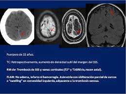 The condition can pose challenges for clinicians. Figure 6 From La Trombosis Venosa Cerebral Un Reto Diagnostico Semantic Scholar